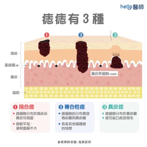 容易長痣|痣變大、痣多或長毛會變皮膚癌？認識痣的形成與原因